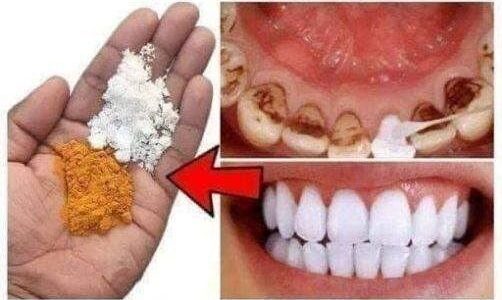 Dentes
