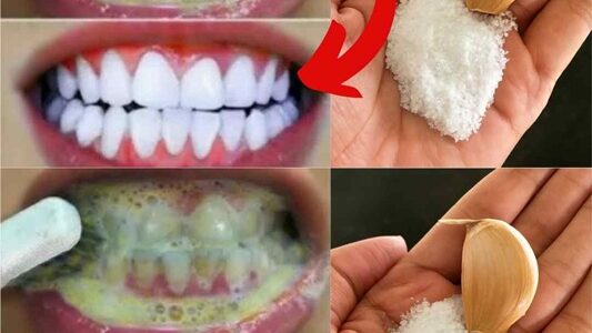 dentes